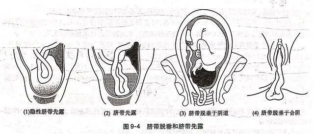 生死一线!危险的脐带脱垂的诊断与应急处理