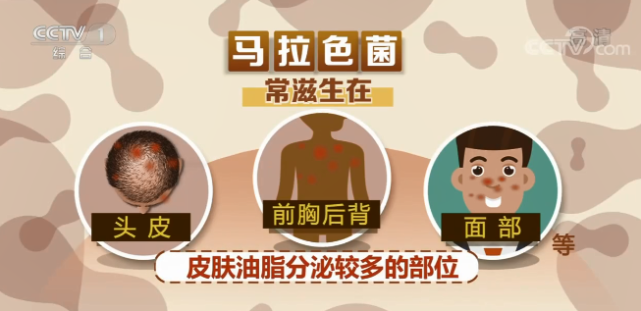 提醒马拉色菌或致永久性脱发一定要当心