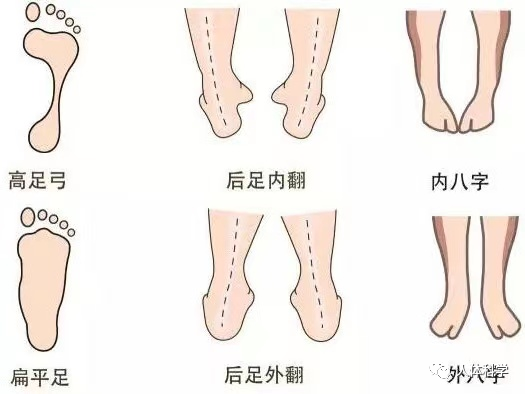 【新体态】踮脚?o型腿?扁平足?外八字?
