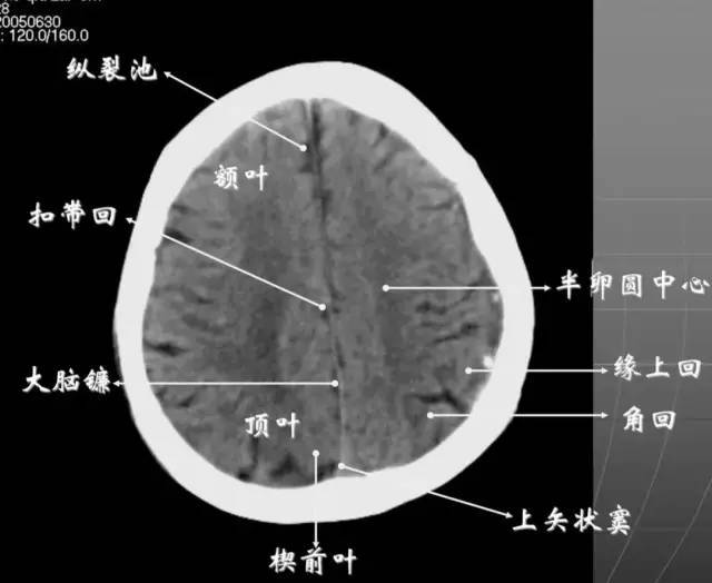 8大脑皮质上部层面(半卵圆区上部层面)已近颅顶,大脑镰清晰可见,其旁