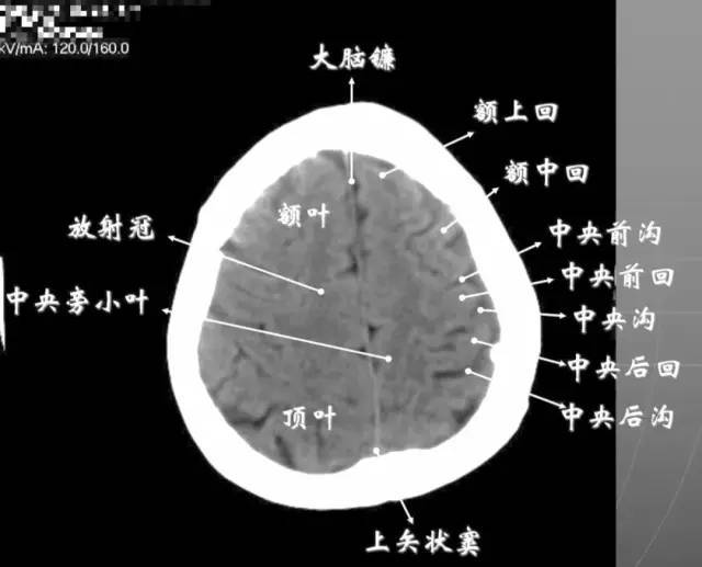 颅脑ct怎么看?正常和异常影像分别是什么?