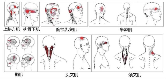 八成头痛和颈椎有关!一份"疼痛位置图解"帮你对症放松