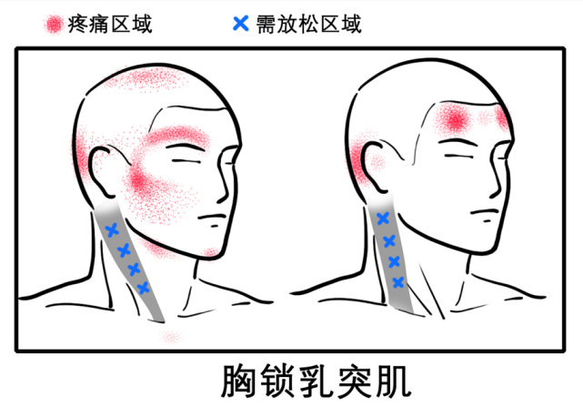 八成头痛和颈椎有关!一份"疼痛位置图解"帮你对症放松