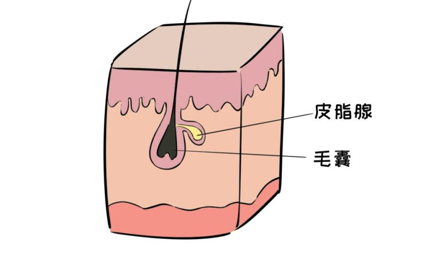 生长激素等)的分泌失衡,尤其是雄激素分泌旺盛时,会导致皮脂腺增生和