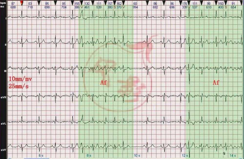 心电图诊断: 窦性心律 阵发性心房颤动伴室内差异