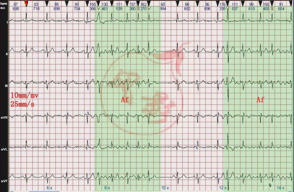 二,知识点: 图中基础心律为窦性,频率83～86bpm,绿色标注部分,可见p波