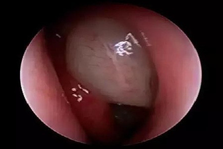 3,鼻息肉:鼻息肉或息肉样变使鼻腔通道变狭,患者通常还伴有慢性鼻炎