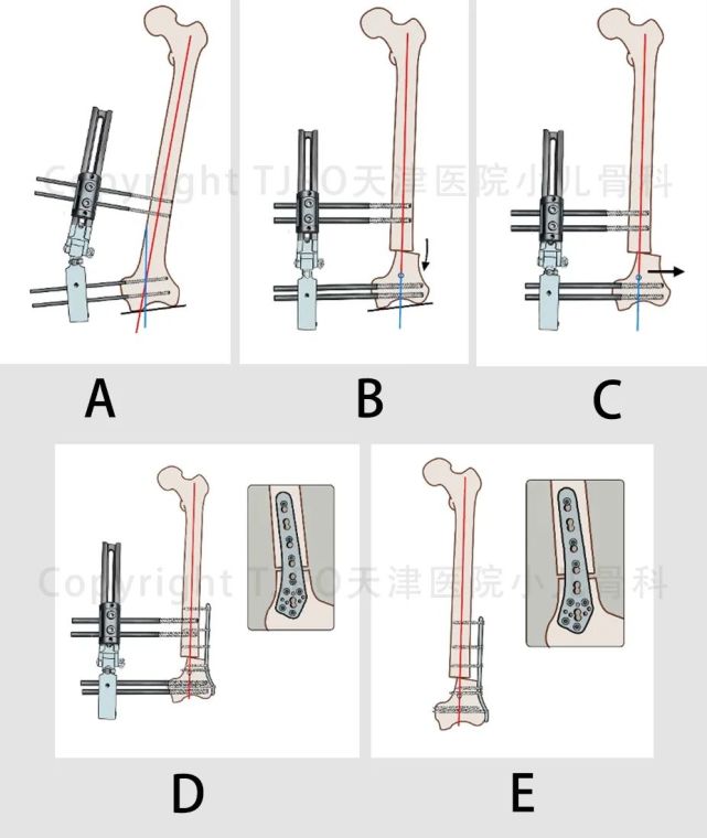 tjpo儿童矫形科普7外固定支架辅助钢板技术矫正股骨远端外翻畸形