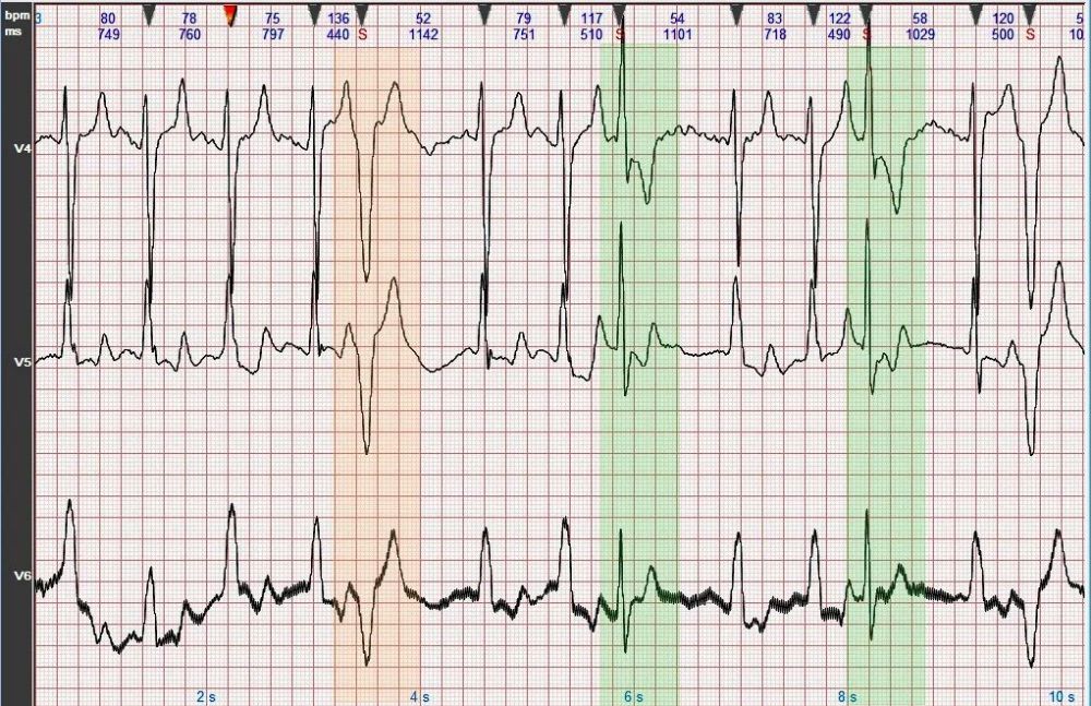 心电图图例分析14完全性左束支阻滞双源性室性早搏