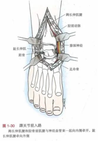 然而, 通过前侧入路显露内外踝均较容 ..