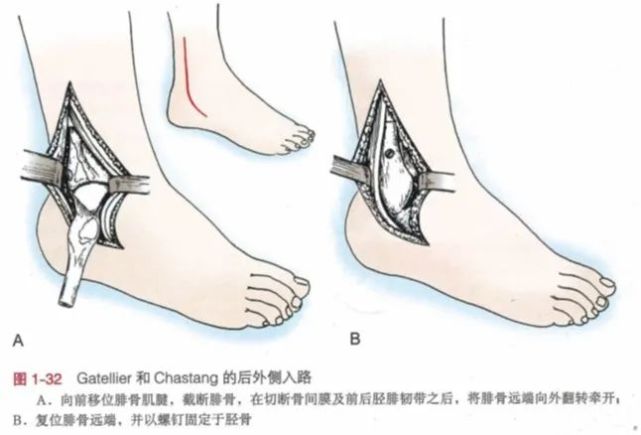 如果腓骨未骨折, 则需在外踝尖近端10 cm 处截断腓骨用以显露.