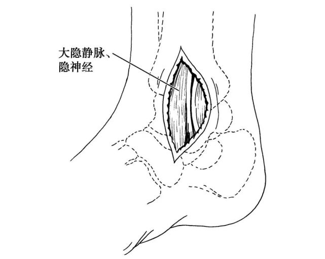 图6-3-21 游离皮瓣并保护大隐静脉及隐神经(2)深层:1)前侧切口:少许