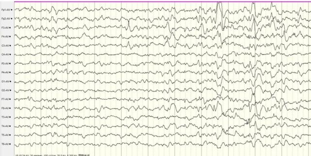 左侧额,中央区可见中高幅尖波,尖慢波,右侧额区,前颞及中颞可见棘波