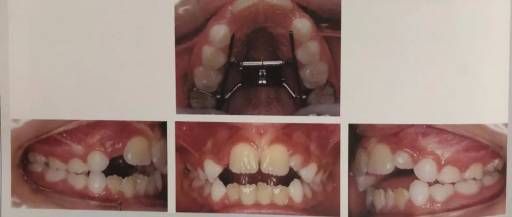 借助扩弓头帽治疗并配合 下颌舌弓治疗的矫正效果(下图) 恒牙萌出后