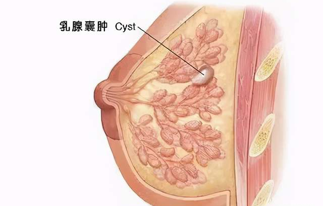 细说乳房囊肿的那些事儿