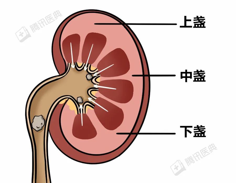 人在站立时,上,中肾盏的结石和重力方向相同;而下部肾盏里的