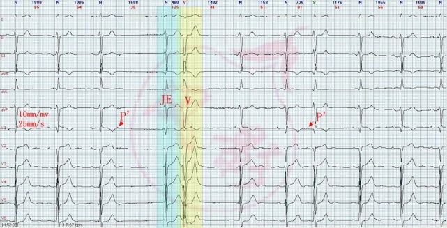 心电图图例分析15:房性早搏末下传,室性早搏,交界性逸