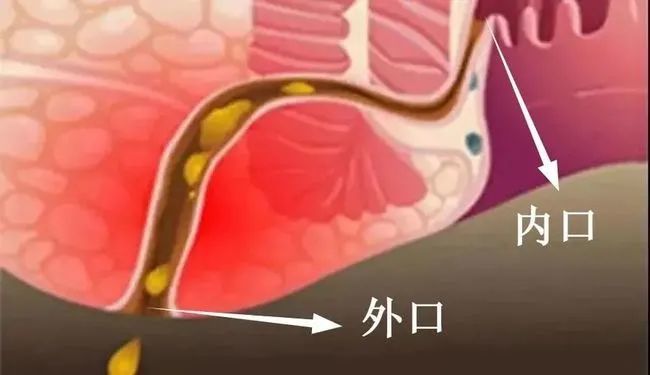 西安东大肛肠医院丨患者提问肛瘘超过10年会癌变吗