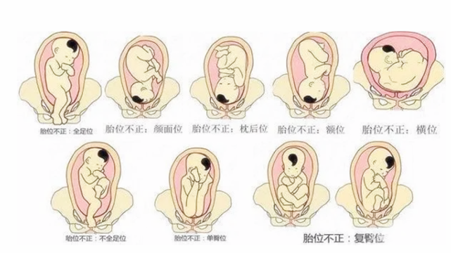 面朝妈妈的方向,后脑勺顶着妈妈的骨盆,这个胎位有利于胎儿使力分娩时