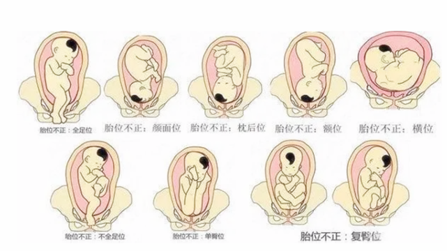 枕后位的区别,今天来细说一二69最后全家还是首选顺产不行再剖腹产