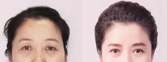 提眉后看着太凶不自然可能是这些原因造成的