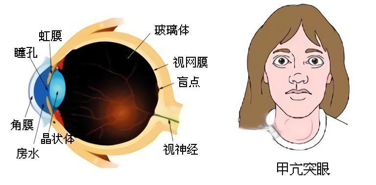 甲亢突眼的症状有哪些该如何预防
