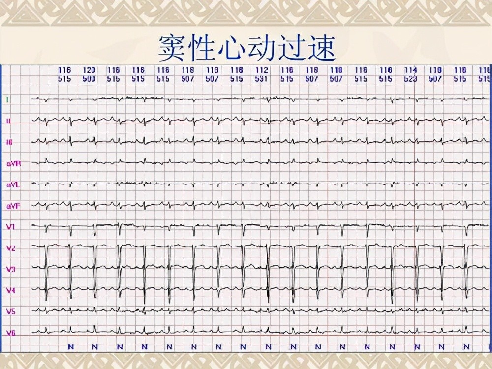 心动过速,应该如何治疗?