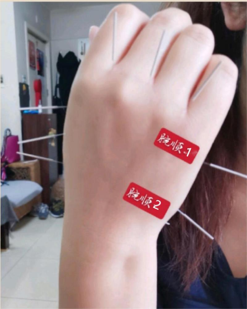 肚脐周围痛:腕顺一穴,腕顺二穴.