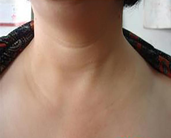 脖子上长小肉粒,还有一种比较严重的现象,那就是已经 患上了淋巴结肿.