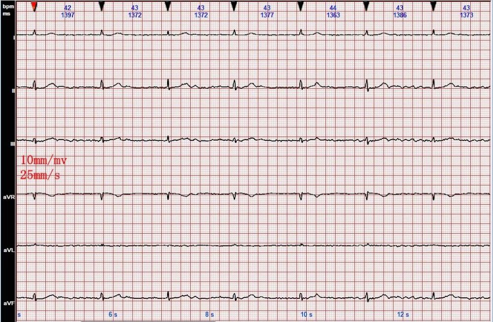 心电图图例分析16:心房颤动,三度房室传导阻滞,交界性逸搏心律