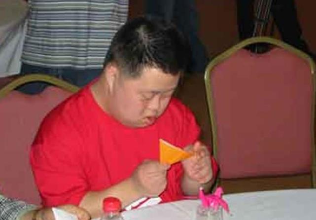 先天性愚型 腾讯网
