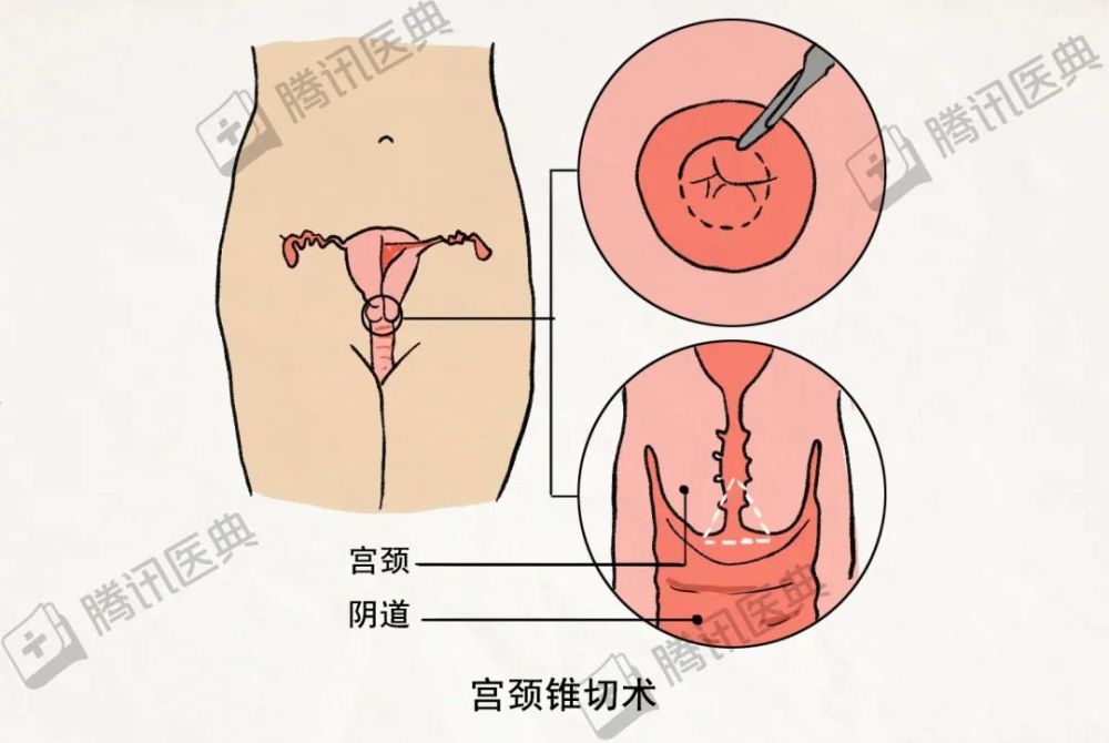 建议做宫颈锥切术,也就是将病变的宫颈切除,以阻断继续发展.