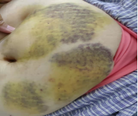 6月18日患者腹部肚脐周围散在大片瘀斑和硬结,如图所示.