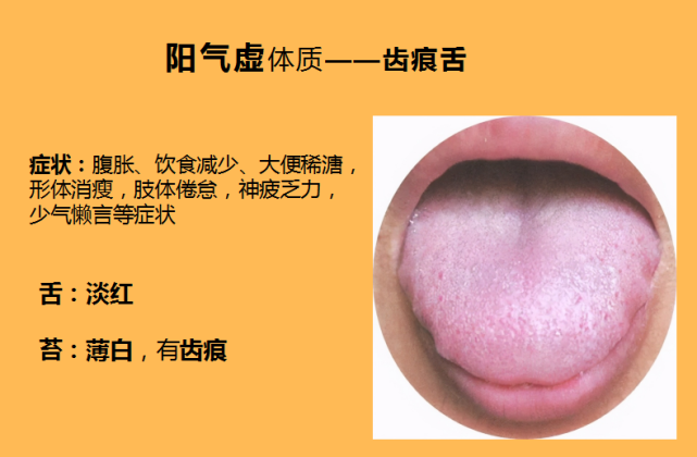 阳气虚体质之人的舌象常见齿痕舌.舌质非常柔软,舌两侧齿痕明显.