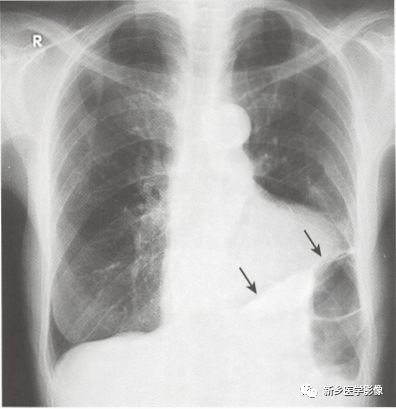 当胸腔积液量达到300mi时,外侧肋膈角变钝,在正位胸片,上可见.