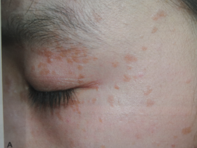 典型皮损:米粒至黄豆大小的扁平隆起性丘疹,圆形或椭圆形,表面光滑,质