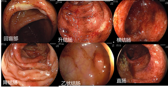 升结肠,横结肠及直肠见多处点片状糜烂,自发性出血,回盲瓣,升结肠