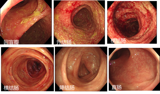 充血水肿,糜烂及溃疡形成,伴自发性出血,横结肠中段以远所见结直肠