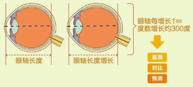 收藏:眼轴长度对照表