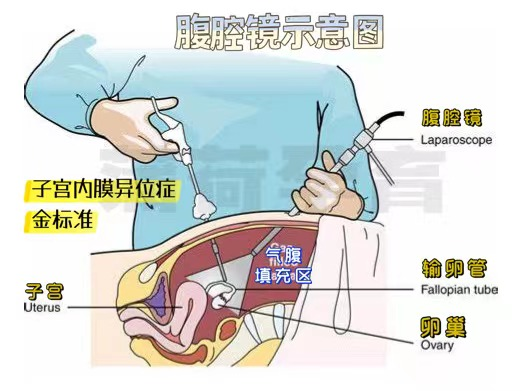 宫腔镜与腹腔镜究竟是怎么样的过程?