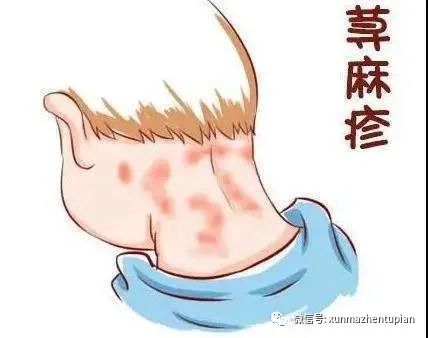 引起冬季荨麻疹的原因