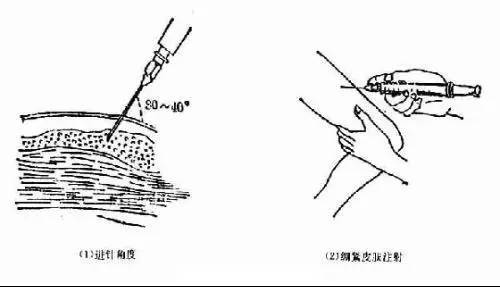 4.待针头斜面进入皮内后,放平注射器,注入药液0.