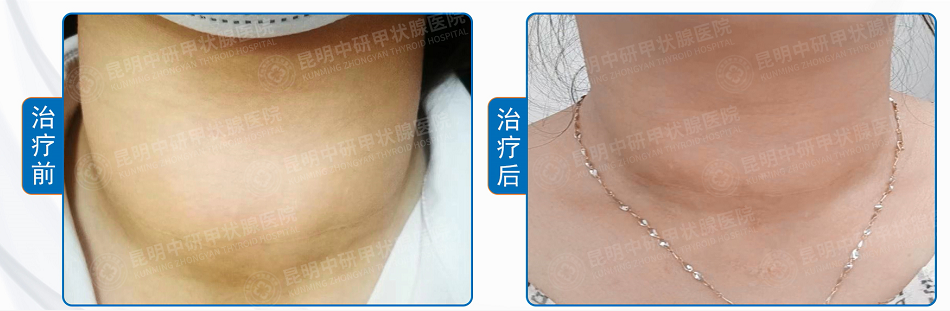 甲亢患者最容易犯的错误你是不是也深陷其中