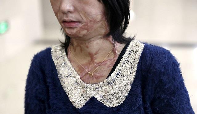 高一女孩周岩:因拒绝富二代追求,便被泼了汽油,后来术后获重生