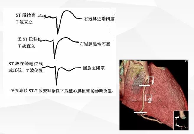 一图详解:急性心肌梗死的判读