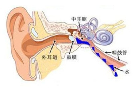 如何判断是否患上了中耳炎