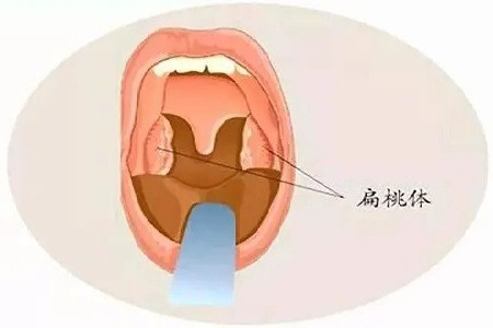 扁桃体肿大的病因较多,常常是由于反复的扁桃体发炎,由于炎症刺激而