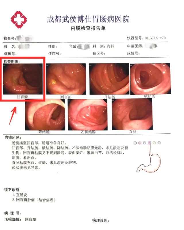 通过肠镜发现,唐先生的回盲瓣黏膜有一块不规则隆起,疑似肠癌病灶.