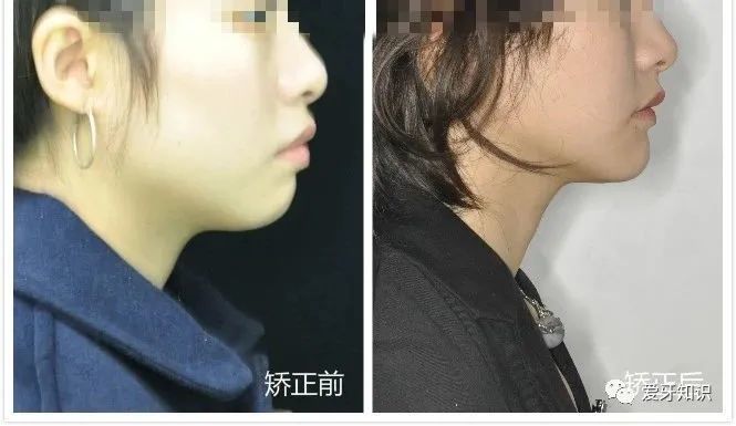 牙齿矫正会导致牙齿松动吗?矫正对脸型有什么变化?