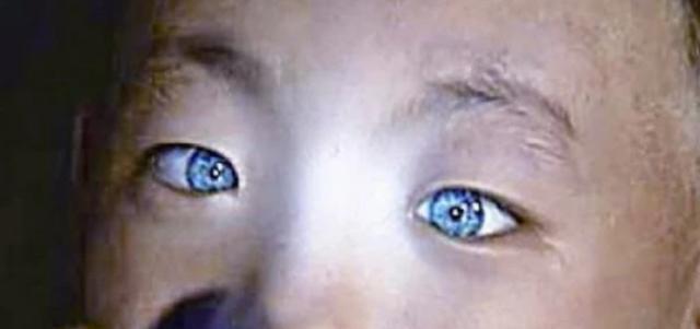 还记得广西的猫眼男孩吗像猫一样能夜视后来检测结果如何
